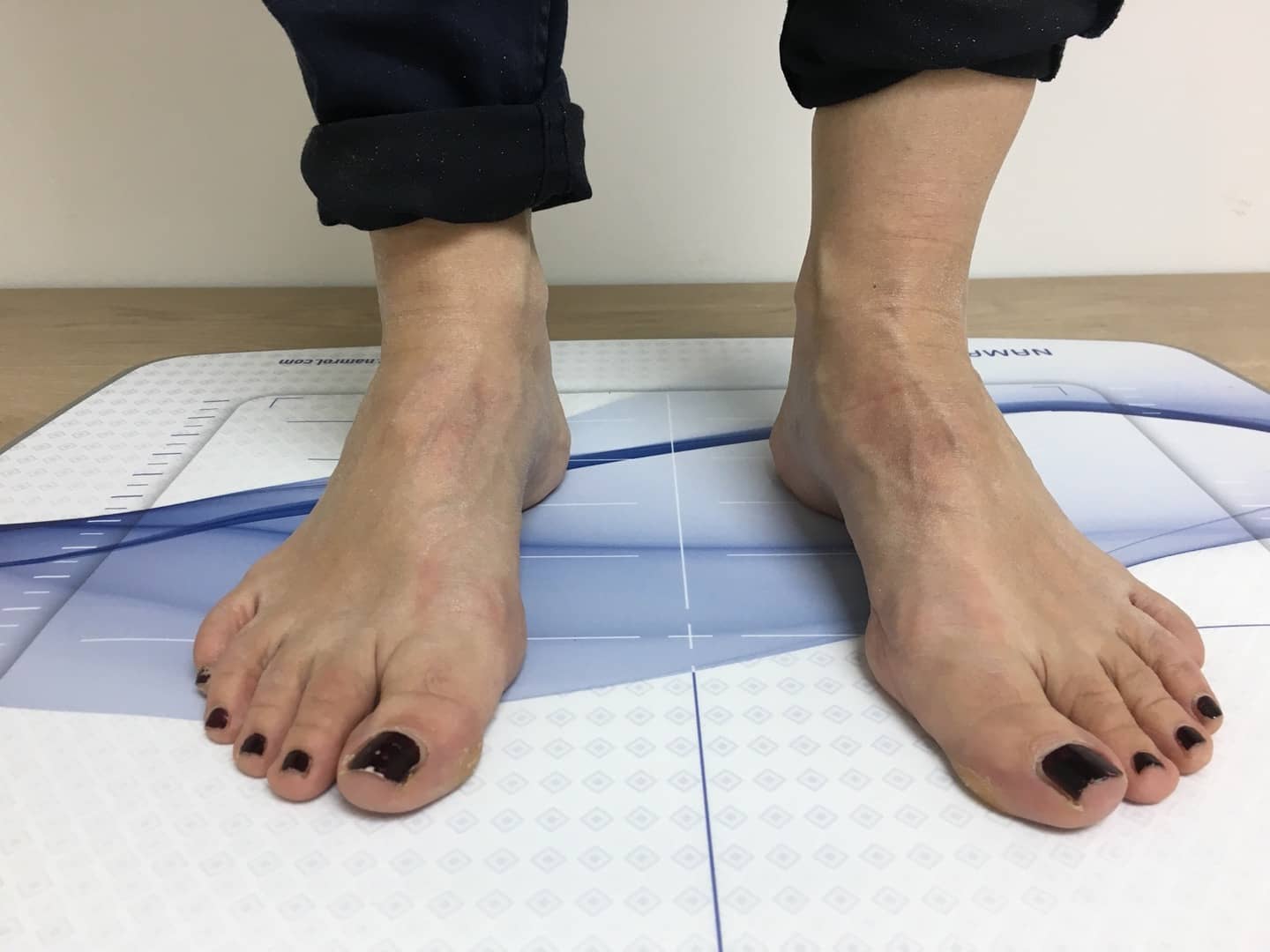 ¿Qué es la fascitis plantar?