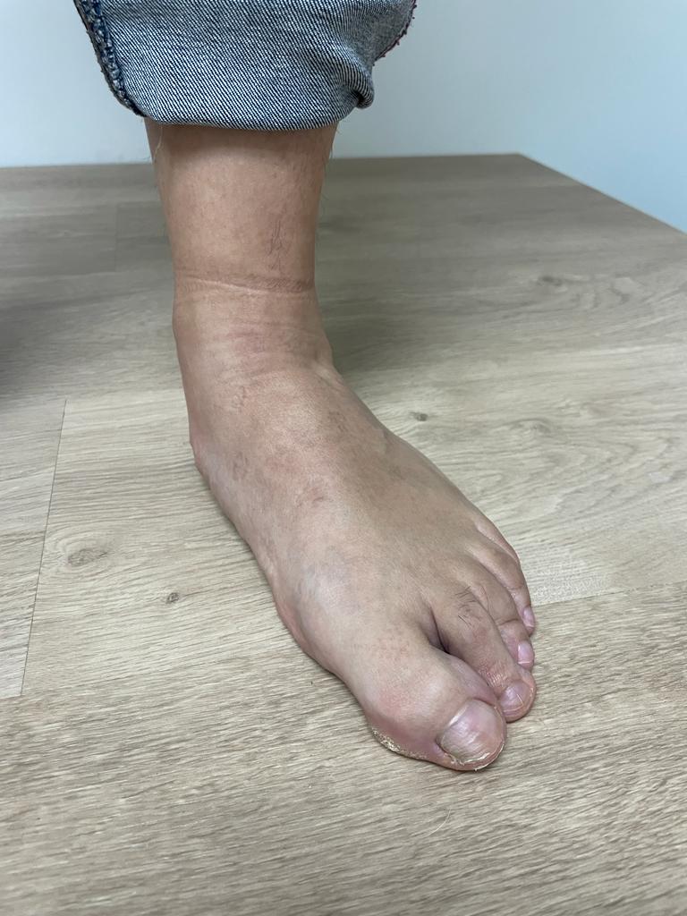 Preguntas y dudas frecuentes sobre patologías del pie